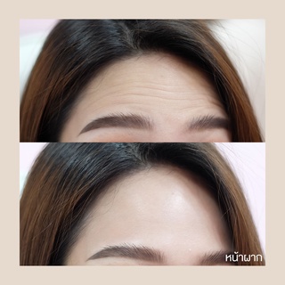 ภาพขนาดย่อของภาพหน้าปกสินค้าBotox (Aestox) Wrinkles โบท็อก ริ้วรอย จากร้าน mekobfillclinic บน Shopee ภาพที่ 6