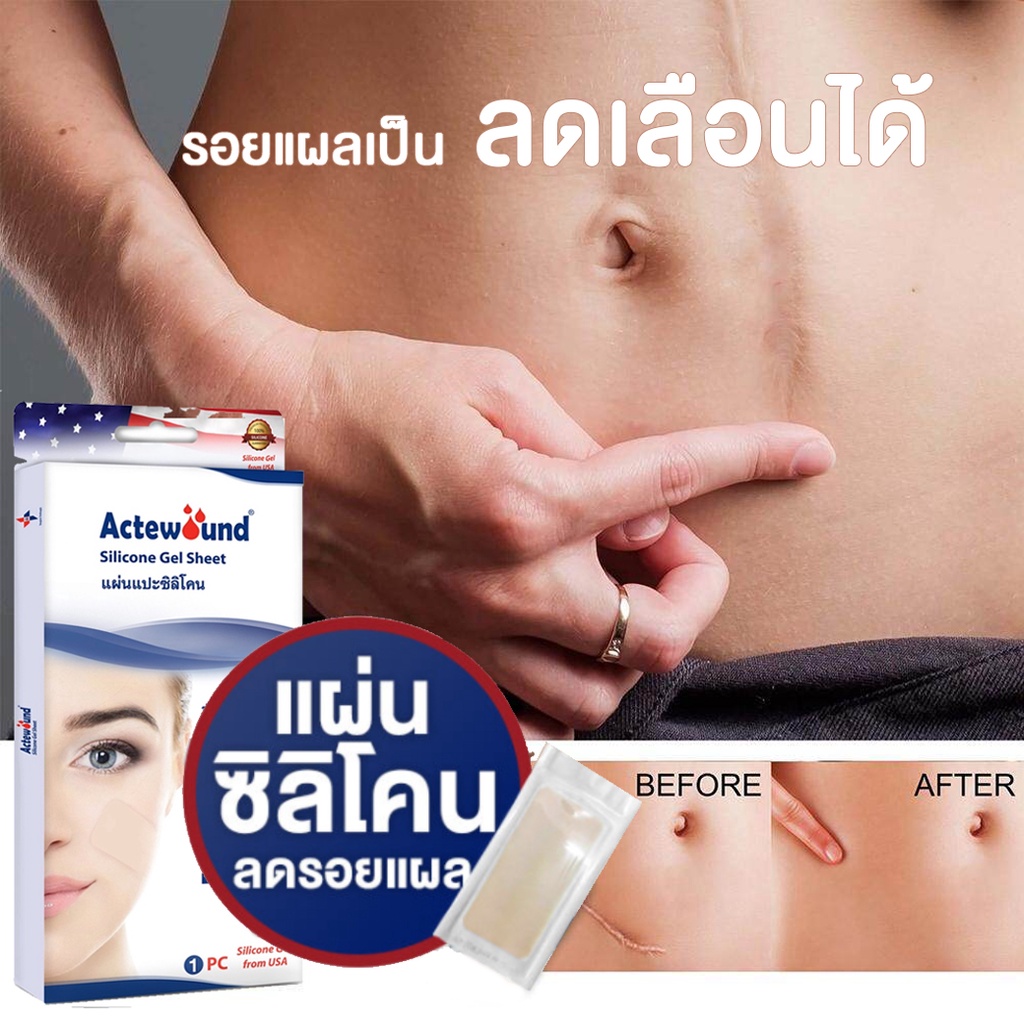 แผ่นซิลิโคนแปะลดรอยแผลเป็น-คีลอยด์-ทั้งเก่าและใหม่-actewound-มี-3-ขนาด