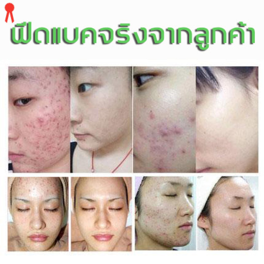 aichunครีมลบรอยดำสิว30mlรักษาสิวอย่างล้ำลึก-ซ่อมแซมรอยสิวและหลุมสิว-ครีมลดรอยสิว-ครีมแต้มสิว-เซรั่มกำจัดสิว-ครีมกำจัดสิว