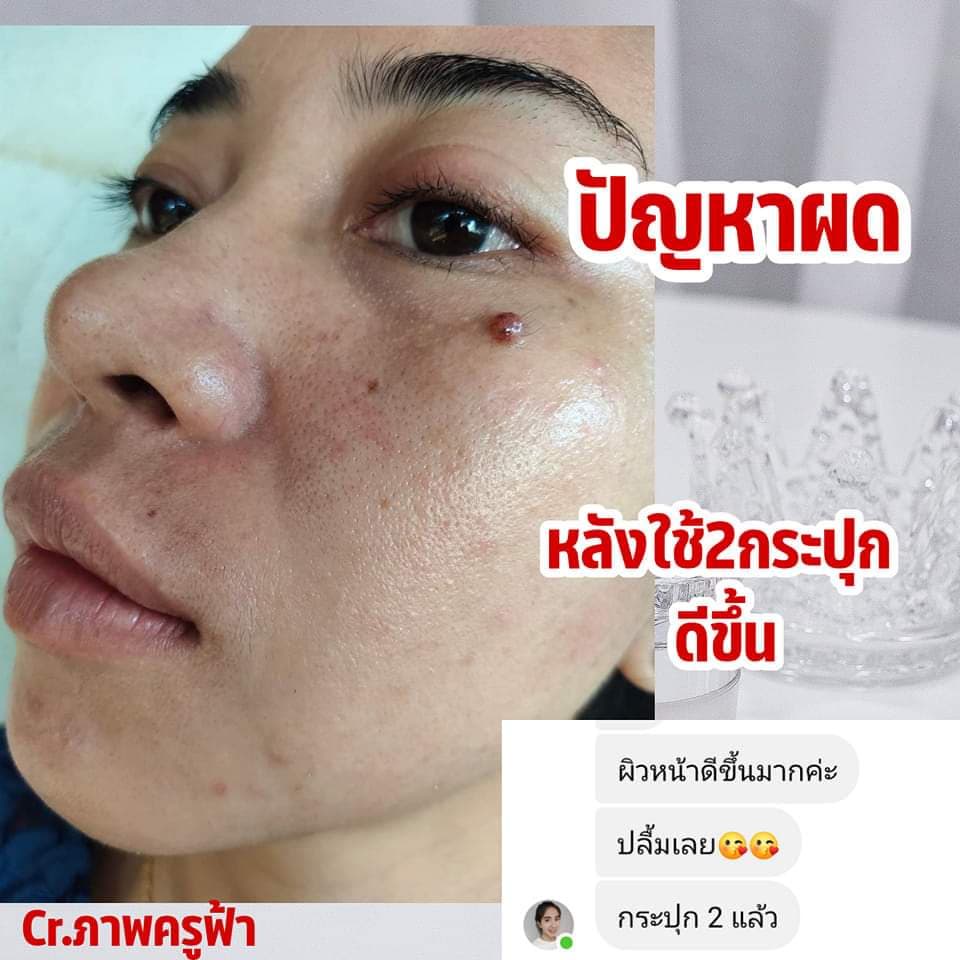 ครีมรากโสมtk-ครีมรากโสมหน้าใส-ครีมรากโสมลดสิวอุดตัน-สลายฝ้ากระ-ลดรอยสิว