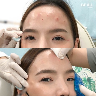 ภาพขนาดย่อของภาพหน้าปกสินค้าBotox (Aestox) Wrinkles โบท็อก ริ้วรอย จากร้าน mekobfillclinic บน Shopee ภาพที่ 3