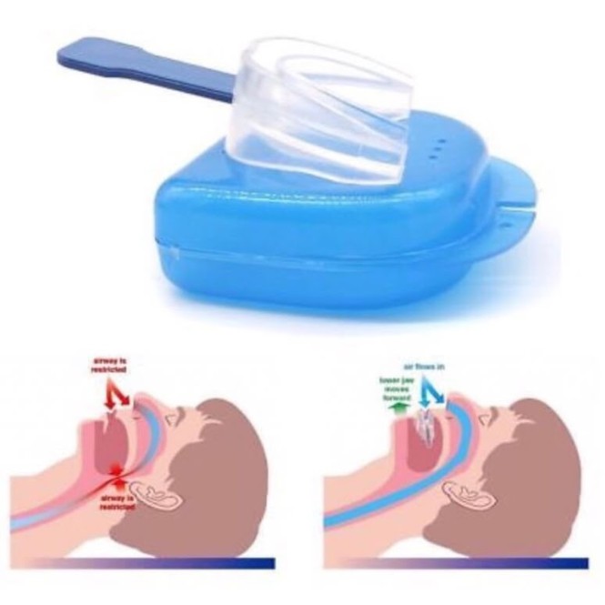 anti-snoring-device-ชุดอุปกรณ์แก้นอนกรนครบเซท-เหลือรุ่นหน้าปก