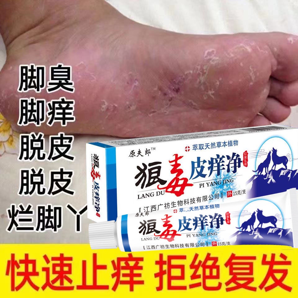 รักษาเท้านักกีฬา-ยาแก้โรคเท้าของนักกีฬา-แก้โรคเท้าเหม็น-ยาเหน็บชาไม่ให้เท้าของนักกีฬากลับมาเป็นซ้ำ
