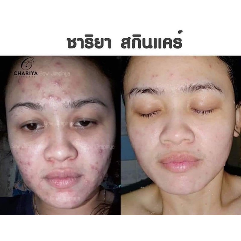 9-9-แถมสบู่-ชุดขายดี-ฝ้า-หน้าใส-1-240-ของแถมมีจำนวนจำกัด