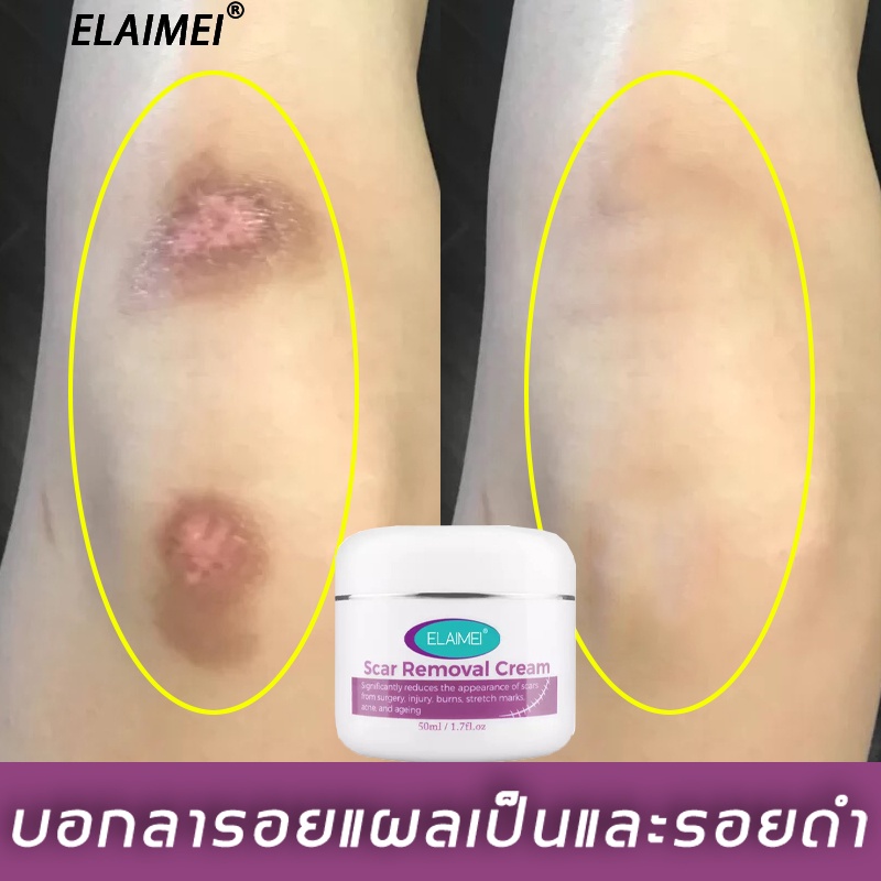 elaimei-50ml-ครีมลดรอยแผลเป็น-ลบรอยครีมแผลเป็น-ครีมรักษาแผลเป็น-ยาทาแผลเป็น-ลดรอยแผลเป็น