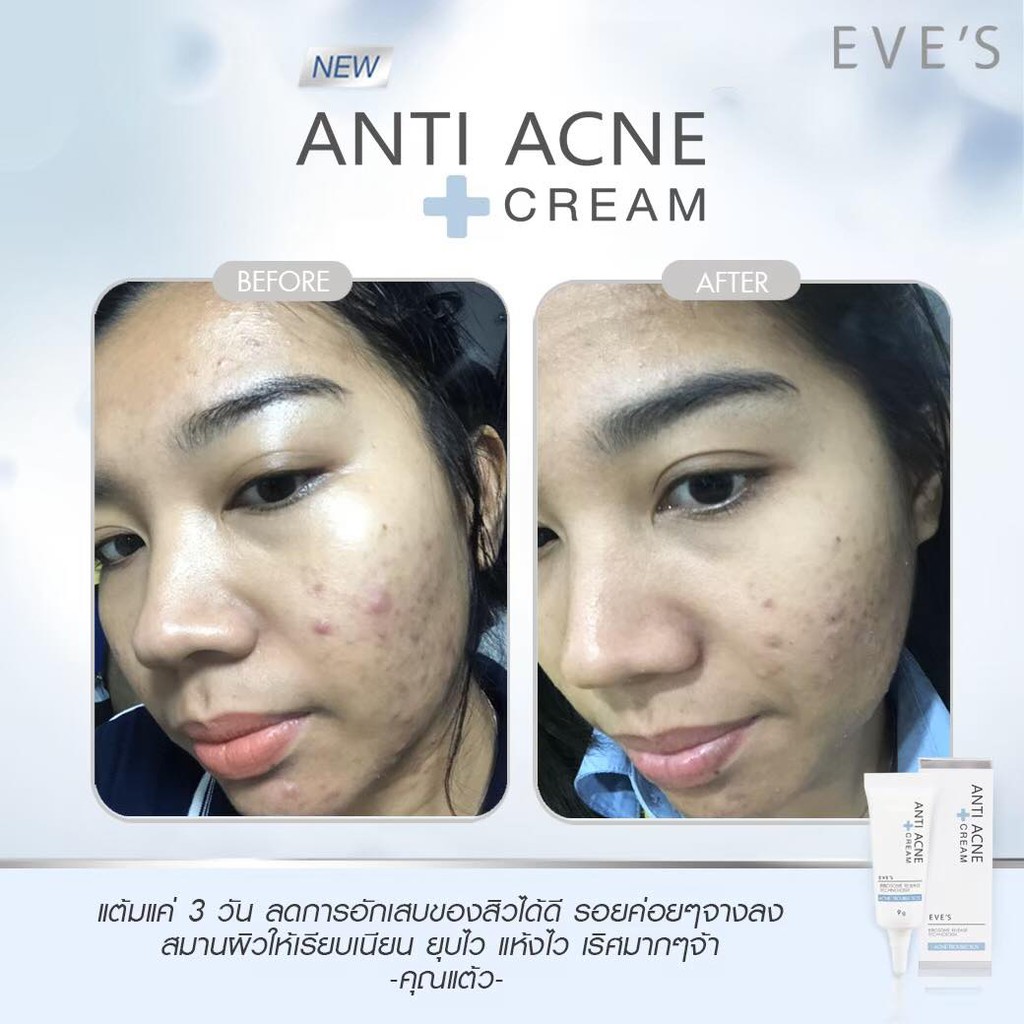 ครีมแต้มสิวอีฟส์-eves-anti-acne-cream-ขนาด-9-กรัม