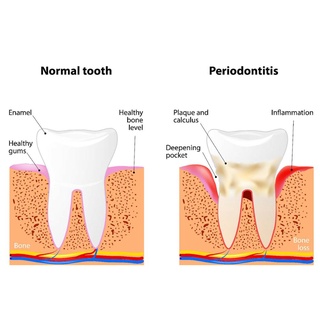 เลือก DENTAL GUM DISEASE &amp; TEETH WHITENING ศิลปะฟิล์มพิมพ์ โปสเตอร์ผ้าไหม ตกแต่งผนังบ้าน 24x36 นิ้ว
