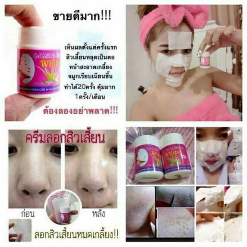 พร้อมส่ง-ครีมลอกสิวเสี้ยนเวียดนาม-ลอกสิวเสี้ยนเวียดนาม-ขจัดสิวเสี้ยน-สิวเสี้ยน-สิวอุดตัน