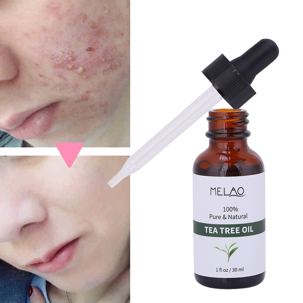 tea-tree-essential-oil-pores-acne-removal-control-facial-massager-skin-care
