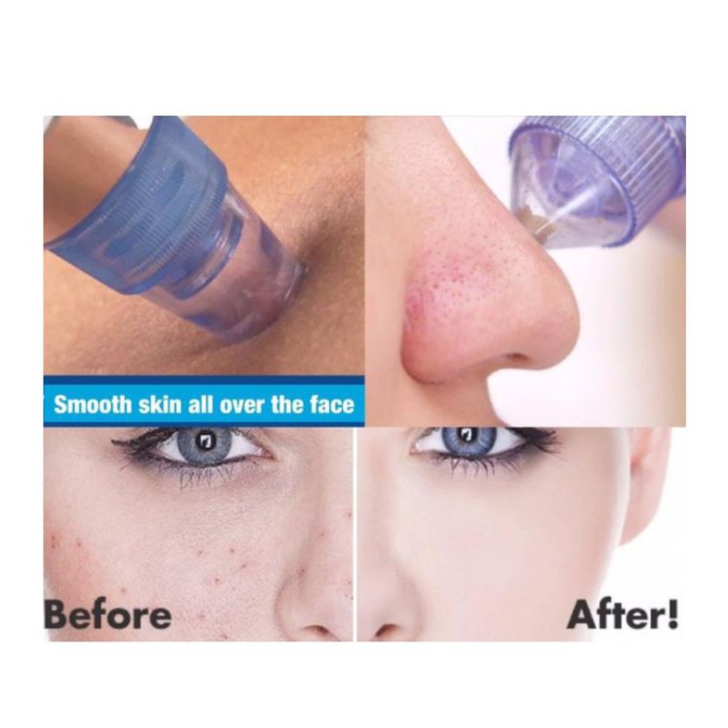 derma-suction-pore-cleansing-device-เครื่องดูดสิวไฟฟ้า