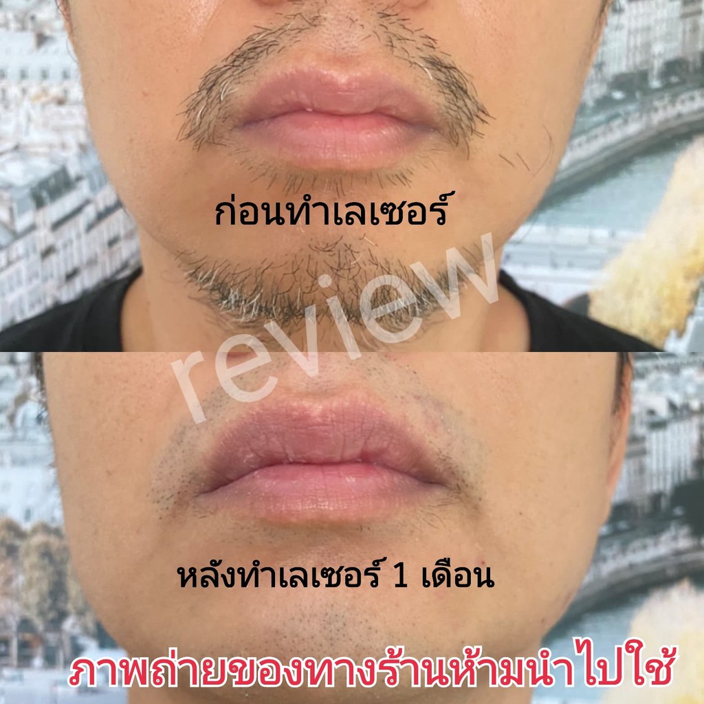 เครื่องกำจัดขนถาวรipl-2in1หน้าใส-กำจัดขน