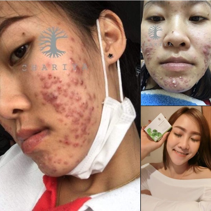 ส่งฟรี-เซตมินิ-เร่งสลายฝ้าไว-x2-พร้อมป้องกันการเกิดฝ้าใหม่-ลดสิว-ครีมชาริยา-ครีมหน้าสวย-สบู่ใบบัวบก-เซรั่มแพลงก์ตอน