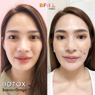 ภาพขนาดย่อของภาพหน้าปกสินค้าBotox (Aestox) Wrinkles โบท็อก ริ้วรอย จากร้าน mekobfillclinic บน Shopee ภาพที่ 4