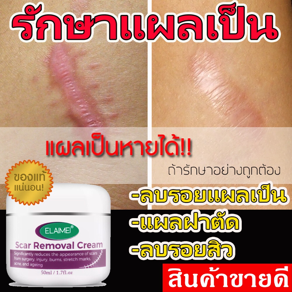 เห็นผล100-ครีมทารอยแผลเป็น-สิว-รอยแตกผิว-50g-ยาทาแผลเป็น-ครีมลดแผลเป็น-เจลทาแผลผ่าตัด-ลบรอยแผลผ่าตัด