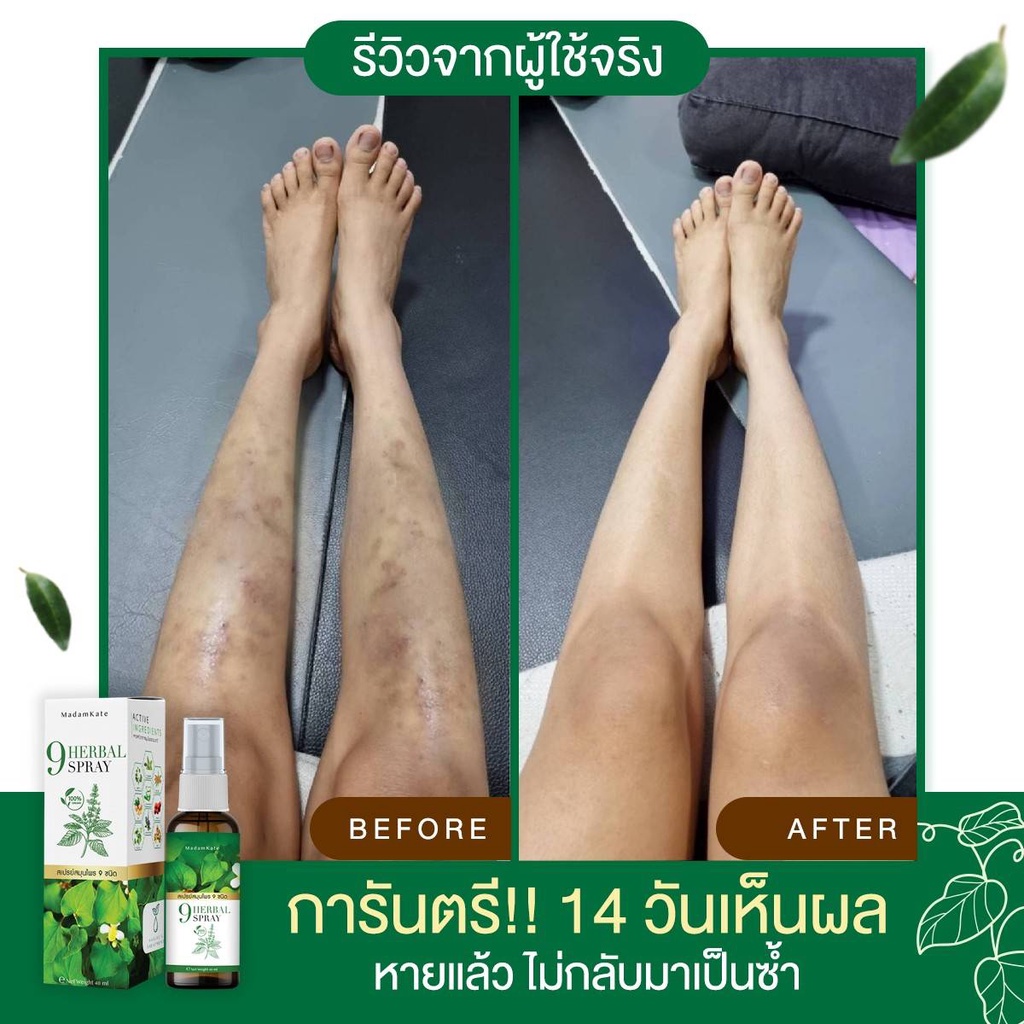 สเปรย์-9-herbal-spray-สมุนไพร9-ชนิดรักษาเชื้อรา-กลากเกลื้อน-ผิวอักเสบ-สะเก็ดเงิน-ผื่นคัน-คันในร่มผ้า-เรื้อนกวาง-เเค่ฉีดก