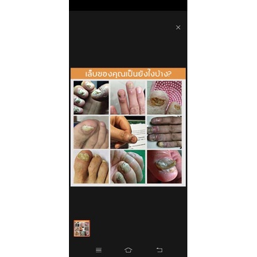 nail-fungus-วิธีแก้ปัญหาการรักษาเชื้อราเล็บ-มือและเล็บเท้าที่แข็งแรงติดเชื้อรา10ml