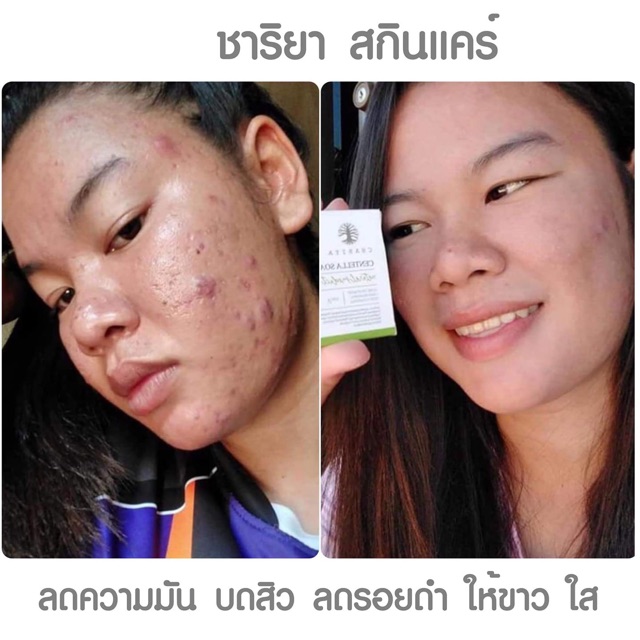 9-9-แถมสบู่-เซ็ทขายดี-ชุด-960-ปราบสิว-ปราบรอยสิว-ของแถมมีจำนวนจำกัด