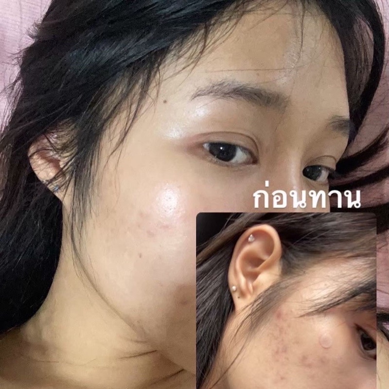 irina-plusx5-ไอริน่าพลัสคอลลาเจนลดสิวผิวใส-กู้ผิวโทรมให้กลับมาปังข้ามคืน