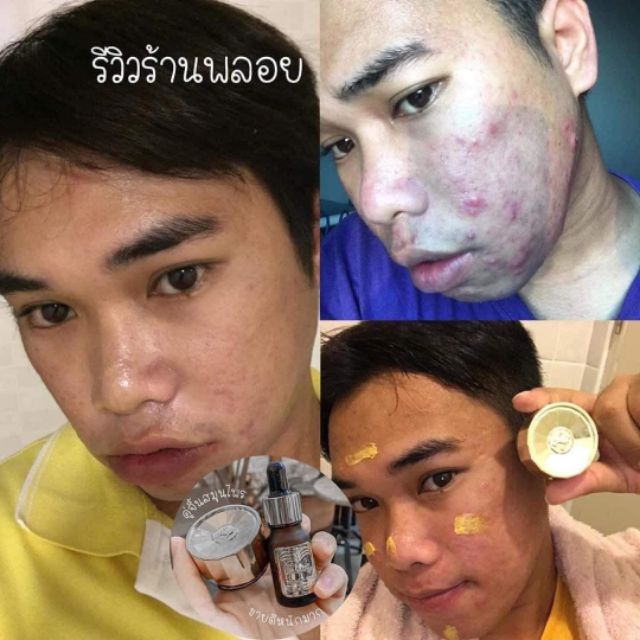 ครีมรักษาสิว-ขมิ้นแท้100-herbal-บอกลาหน้าสิว-แก้ปัญหาคนมีสิวโดยเฉพาะ-ของแท้-มี-อย