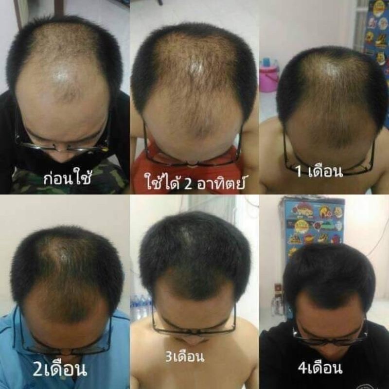 ปลูกผม-นีโอแฮร์-โลชั่น-neo-hair-lotion