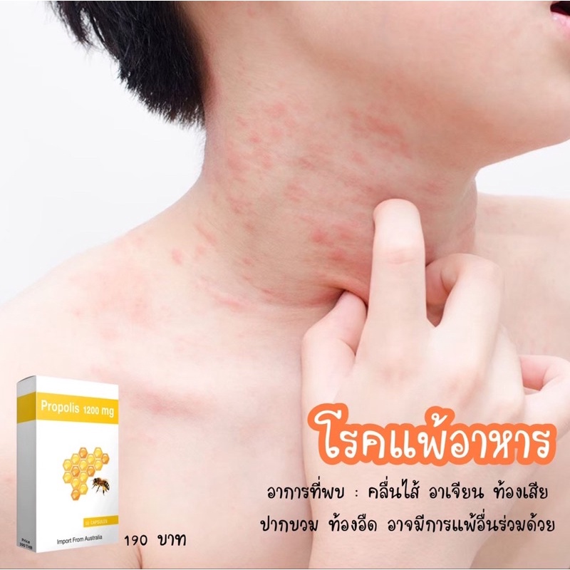 propolis-พรอพอลิส-แผลอักเสบ-สิว-ภูมิแพ้