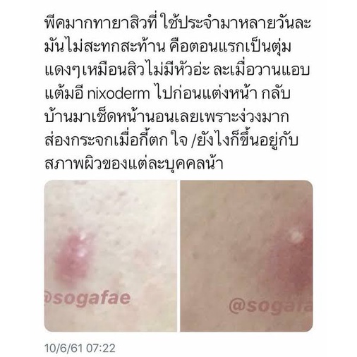 nixoderm-ครีมรักษาสิว-สิว-สิวอักเสบ-สิวอุดตัน-สิวผด-ผื่น-กลากเกลื้อน-อาการคัน-เชื้อรา-บรรเทาอาการคันตามผิวหนัง-ผลิต07-21