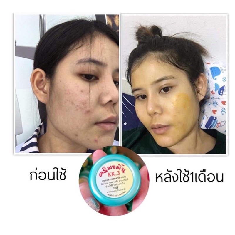 ครีมขมิ้นkk3สมุนไพรรักษาสิว-ครีมขมิ้นสด-ใส่โค้ด-dnshkk10-รับส่วนลดทันที