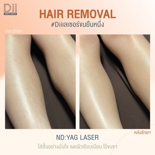 ภาพขนาดย่อของภาพหน้าปกสินค้าDii Aesthetic : Hair Removal Package S จากร้าน dii_aesthetic บน Shopee