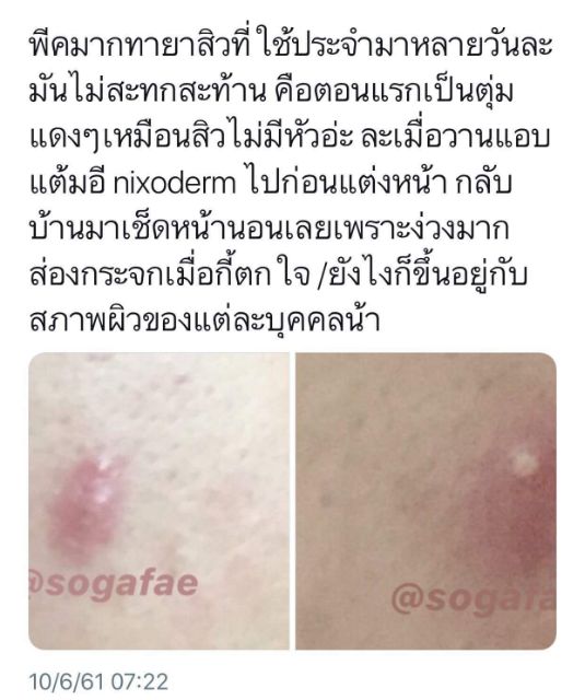 nixoderm-ครีมแต้มสิวตัวดัง-รีวิวแน่นม๊ากกก