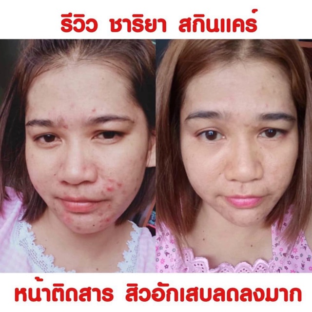 9-9-แถมสบู่-เซ็ทขายดี-ชุด-960-ปราบสิว-ปราบรอยสิว-ของแถมมีจำนวนจำกัด