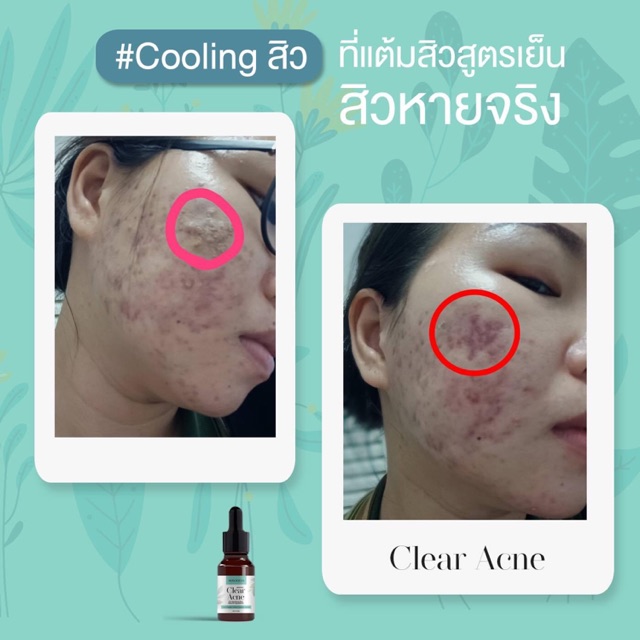 เซรั่มแต้มสิว-ลดการอักเสบ-skinlicious