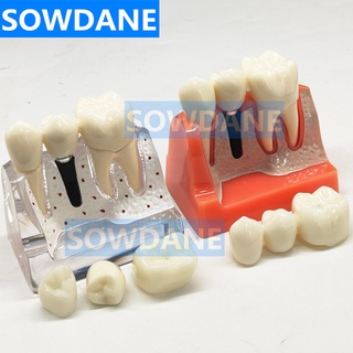 4 Times Dental Implant Disease Analysis with Restoration Crown Bridge Demonstration Dental Teeth Teaching study Model