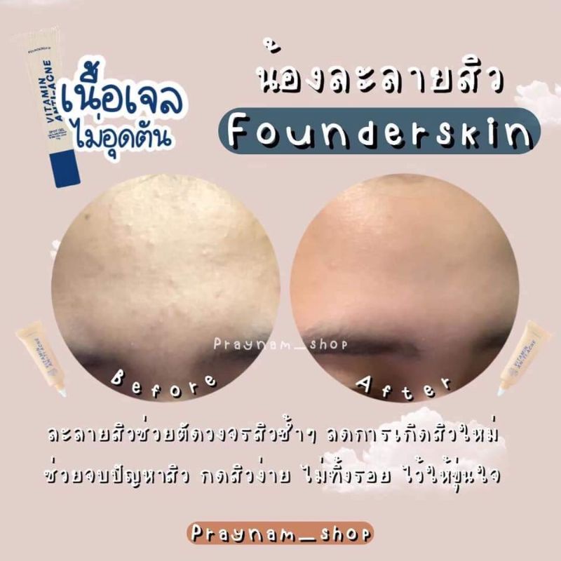 เจลละลายสิว-เจลละลายสิว-founderskin-ละลายสิว