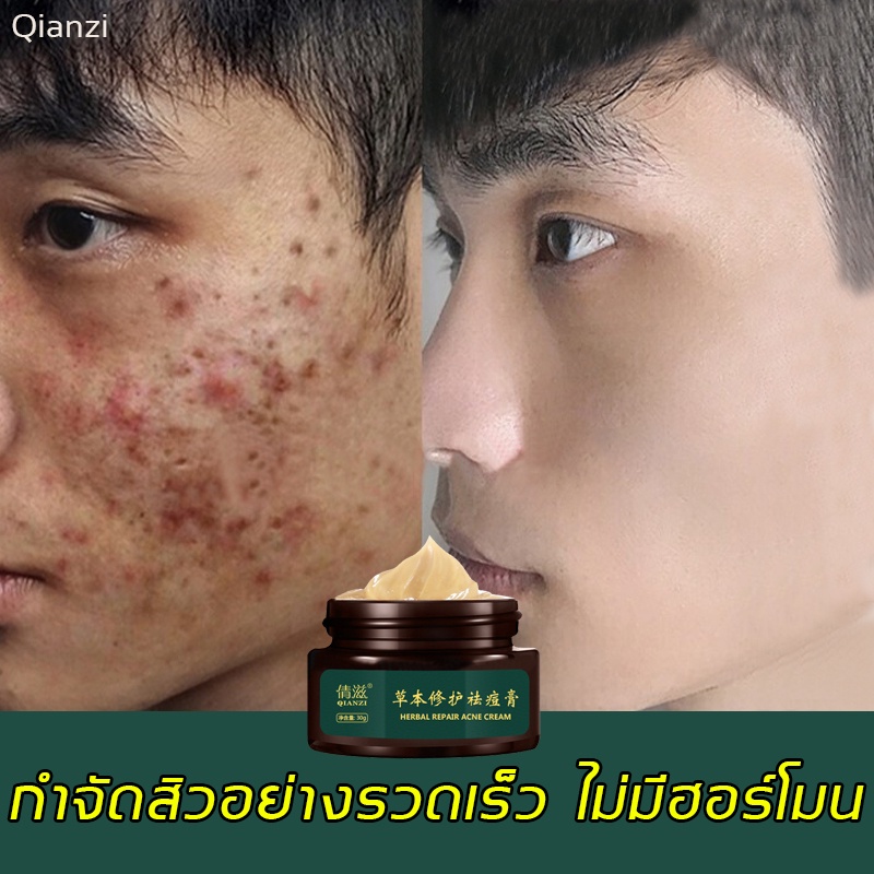 qianzi-30g-ครีมลดสิว-กำจัดสีว-ครีมลบรอยดำสิว-ลดสิวอุดตันหัวปิด-กำจัดสิวอักเสบ-ครีมแต้มสิว-ครีมลบรอยดำสิว