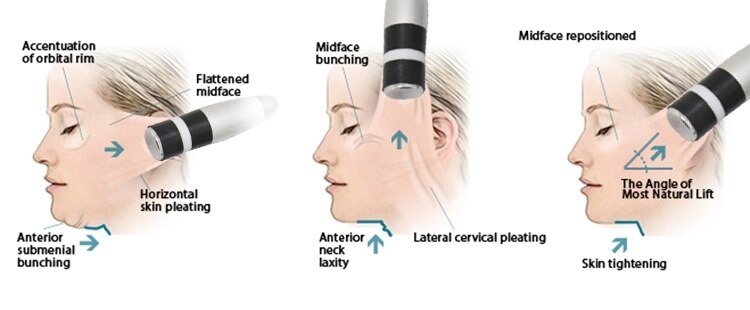 skin-cool-cryo-cool-เครื่องยกกระชับผิวหน้า-ด้วยไฟฟ้า-ไม่ต้องใช้เข็ม