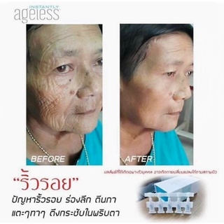 ครีมลบรอยเหี่ยวย่น รอยตีนกา หลุมสิว  ภายใน 2- 3  นาที 5 หลอด ราคาพิเศษ 599บาท