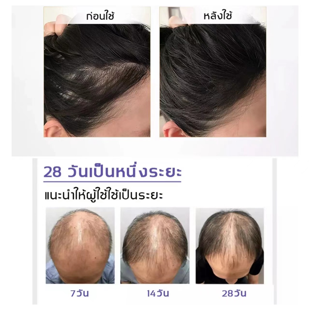 น้ำยาปลูกผม-เซรั่มปลูกผม-ปลูกผม-เร่งผมขึ้นใหม่-caizilanรักษาผม-ลดผมร่วง-หยุดผมร่วง-รักษาผมร่วง-น้ำยาปลูกผมผู้ชาย20ml