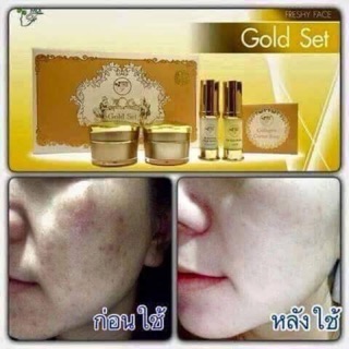 Gold set หน้าขาวใส ไร้สิว