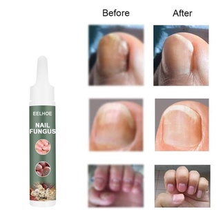 Nail Fungus20ml วิธีแก้ปัญหาการรักษาเชื้อราเล็บ มือและเล็บเท้าที่แข็ง