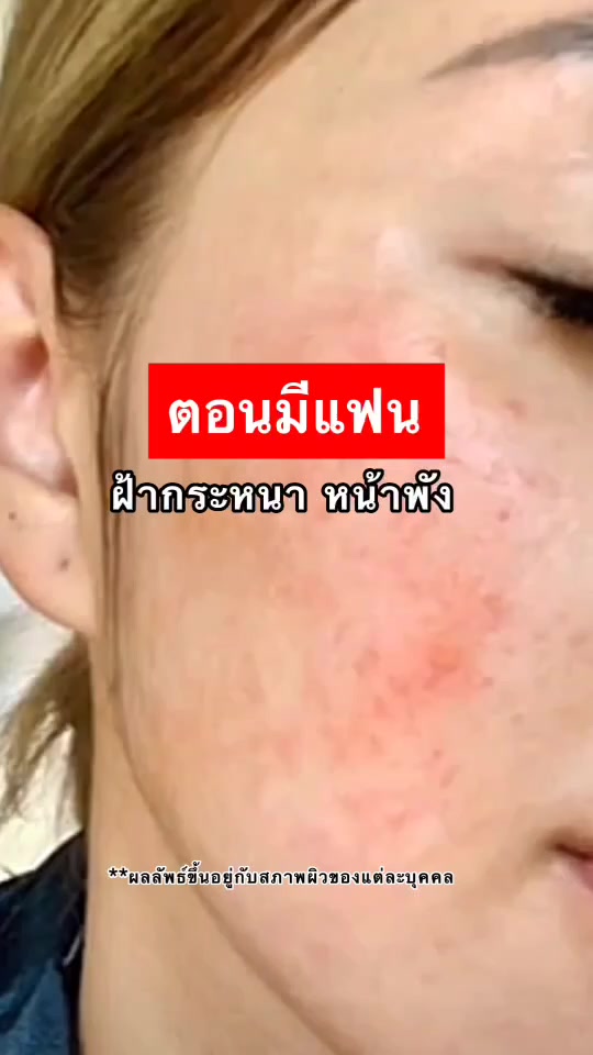 วิตามิน-tm-ขาวไวกว่าฉีด-ดำแดด-ดำกรรมพันธุ์-วิตามินซี-วิตามินเข้มข้น-vitamin-ผิวขาวใส-ผิวอมชมพู-ปราบสิว-ฝ้า-กระ