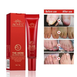 ( Ready Stock ) ทรีทเมนท์บํารุงเล็บเท้าป้องกันเชื้อรา