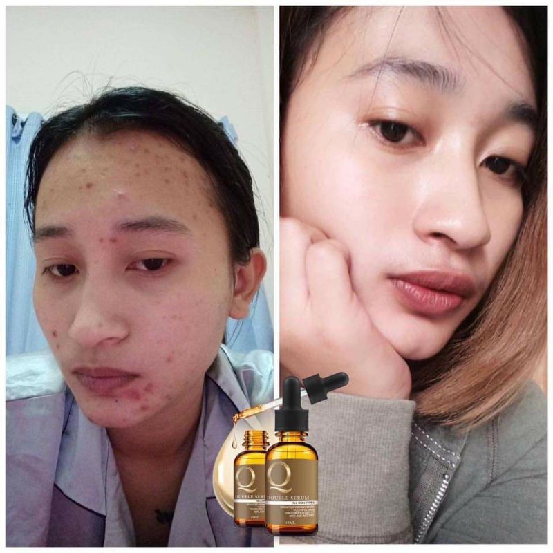 เซรั่มคิว-q-douber-serum-เซรั่มสลายฝ้า-หน้าเด็ก-แท้100