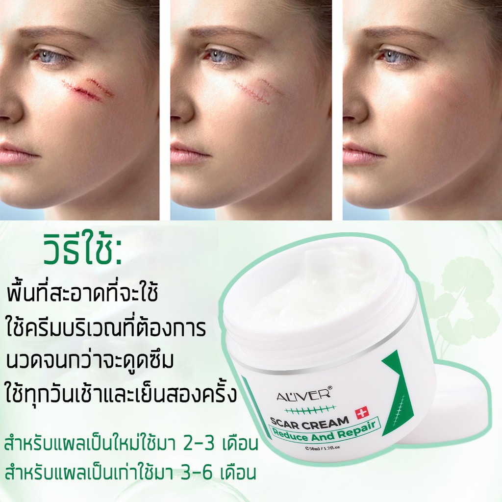 aliverครีมลดรอยแผลเป็น50ml-รอยแผลเป็นจางลงและช่วยสมานผิว-ครีมกำจัดรอยแผลเป็น-ครีมลดรอยแผลเป็น-ครีมรักษาแผลเป็น-ครีมซ่