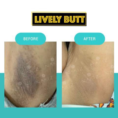 nakiz-lively-butt-100-ml-แก้ปัญหา-ก้นดำ-รักแร้ดำ-ขาหนีบดำ-ลบเลือนรอยดำ-มีสินค้าในไทย