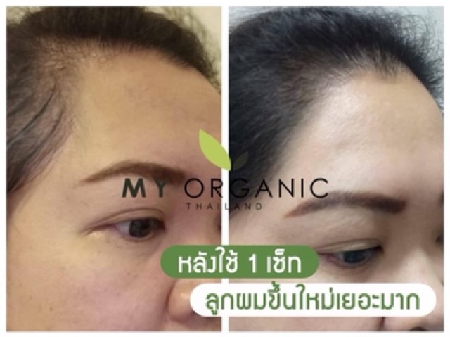 ส่งฟรี-my-organic-hair-tonic-บำรุงเส้นผม-เพิ่มปริมาณเส้นผม-การันตีจากรางวัลทั่วโลก