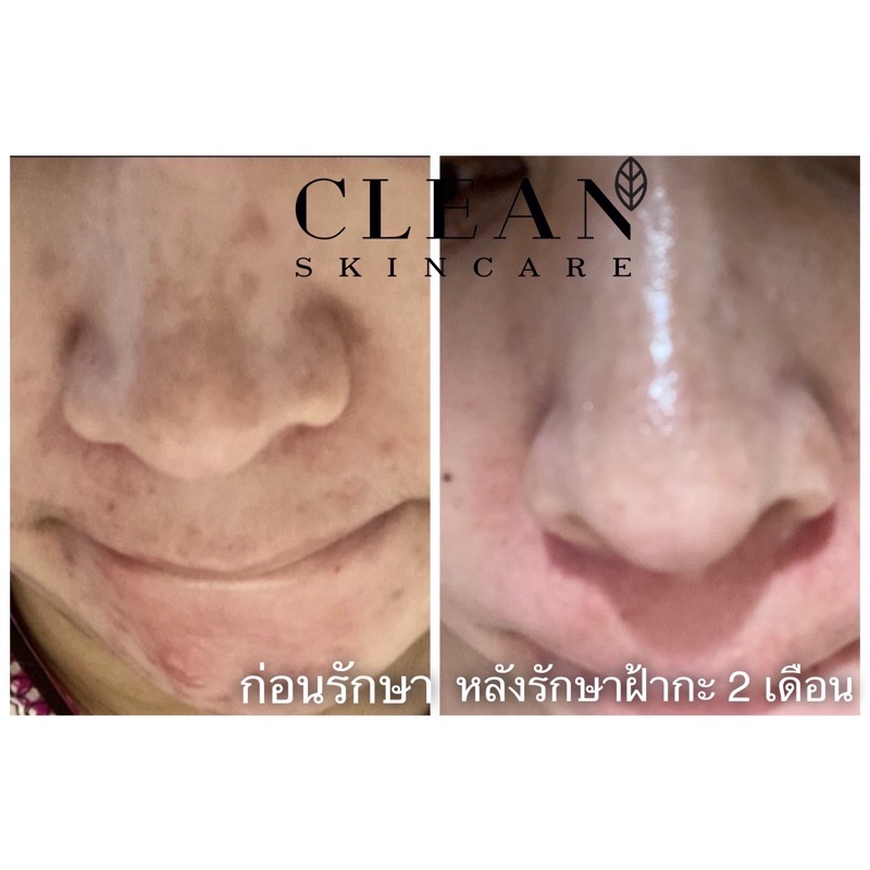 ครีมลดฝ้ากระ-whitening-cream-spot-treatment