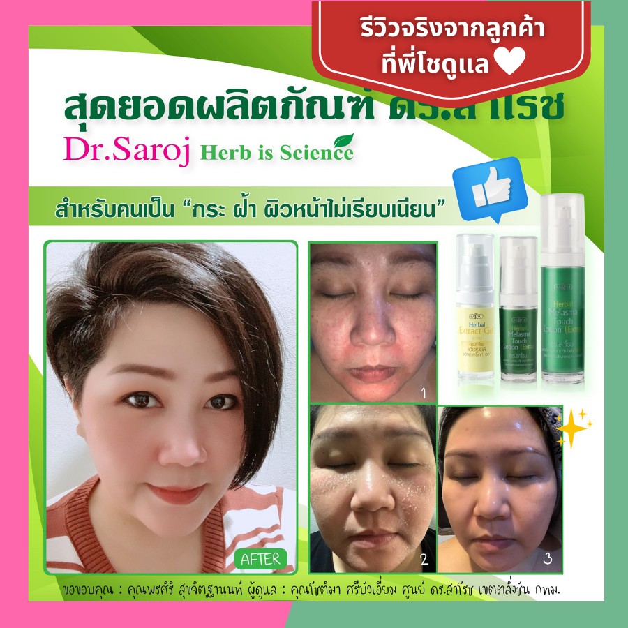 chocenter-setรักษาฝ้า-ผิวมัน-สูตรเข้มข้น-ฝ้าหายไวติดสปีด