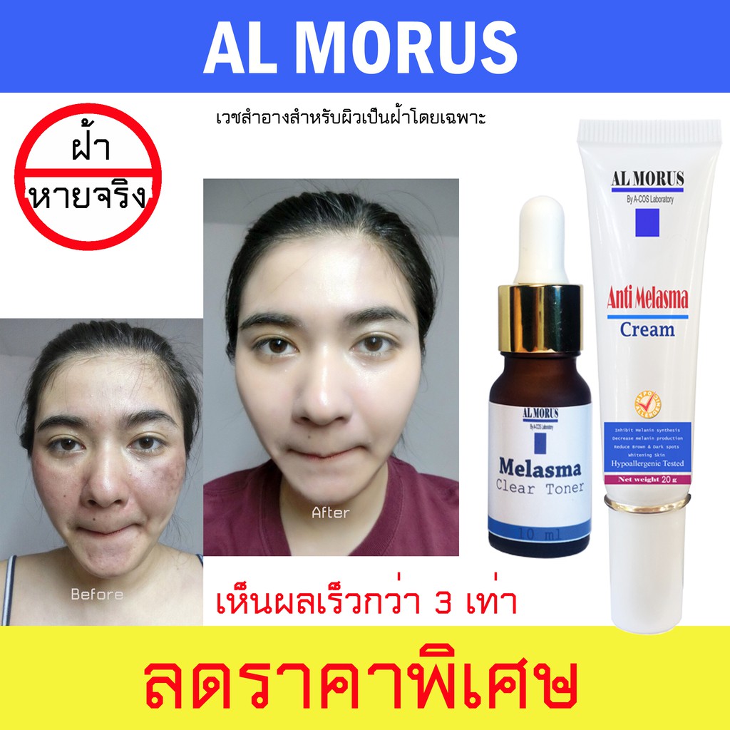 al-morus-anti-melasma-cream-amp-melasma-clear-toner