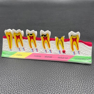 อุปกรณ์ทันตกรรม Caries Classify Tooth Model of Pathological Process Around Teeth Caries Evolution Decayed Model