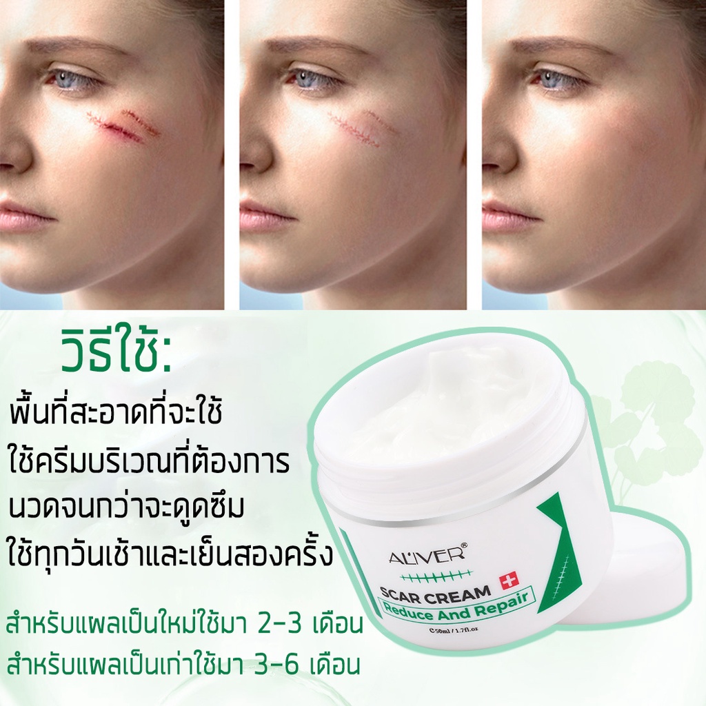 aliver-ครีมลดรอยแผลเป็น-ครีมรักษาแผลเป็น-ครีมลบแผลเป็น-ครีมรักษาแผลเป็น-ครีมลบแผลเป็น-แผลไฟไหม้-รอยแตกลาย-ซ่อมแซมผิวหนัง